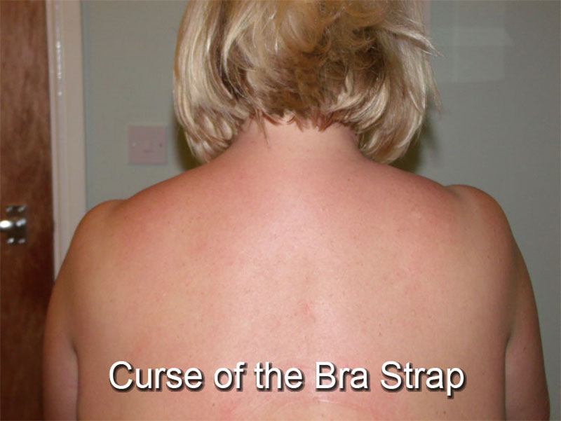 therapyroom1 picture of a woman which bra strap syndrome